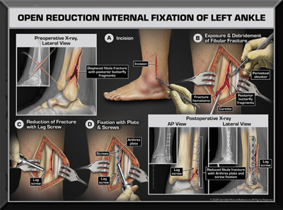 Ankle ORIF Surgery Medical Trail Exhibit