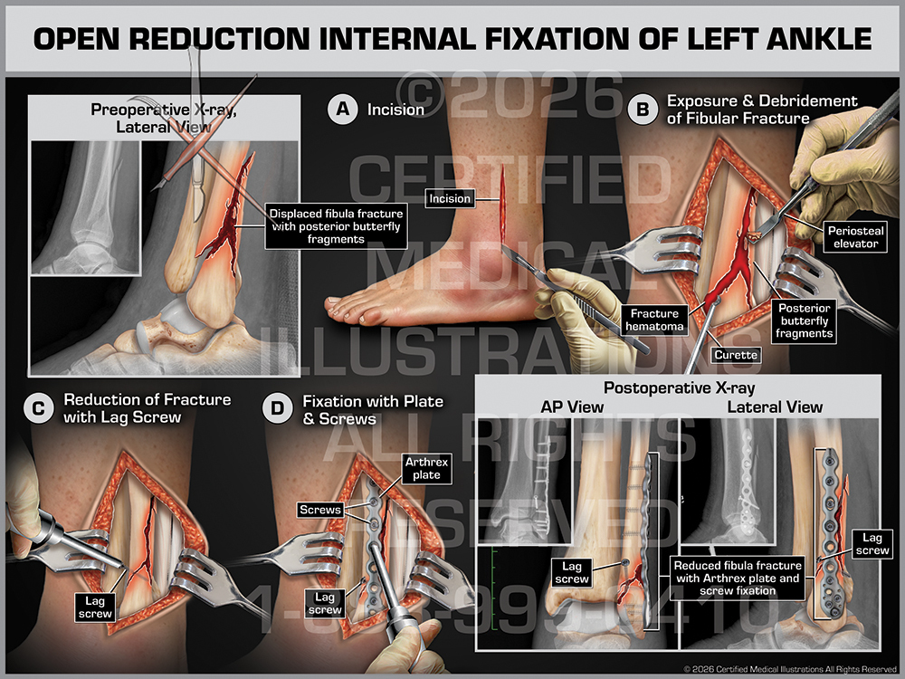 Ankle ORIF trial exhibit