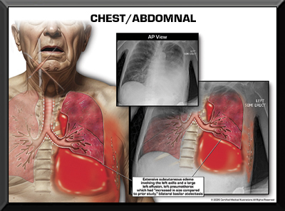 Colorized film Chest Back Abdomen Trial Exhibits