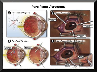 Eye Surgery Medical Trail Exhibit