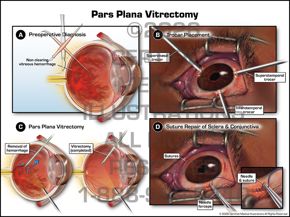 Eye trial exhibit