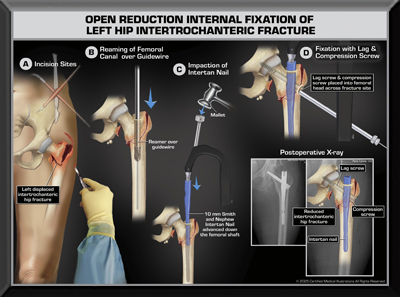 Femur Medical Trial Exhibit