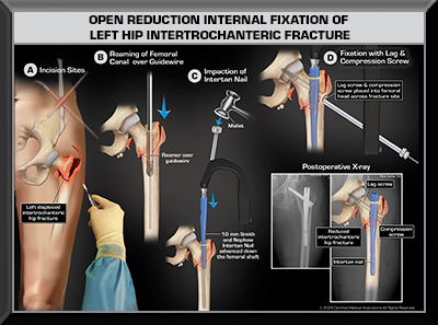 Femur Medical Trial Exhibit