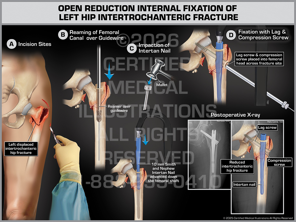 Femur Fracture Surgery Medical Trial Exhibit