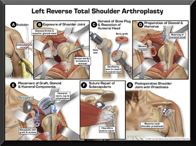 Amputation Medical Trial Exhibit