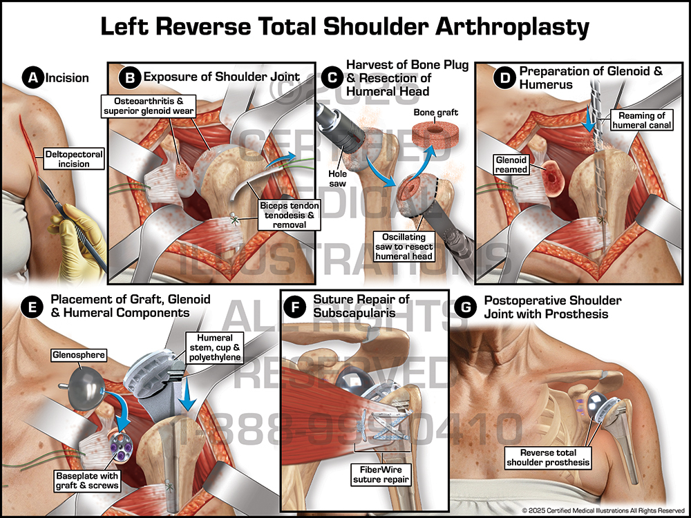 Below Knee Amputation medical trial exhibit