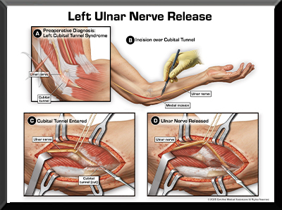 Wrist Fracture Medical Trial Exhibit