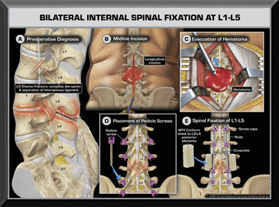 Lumbar Fusion Trial Exhibit