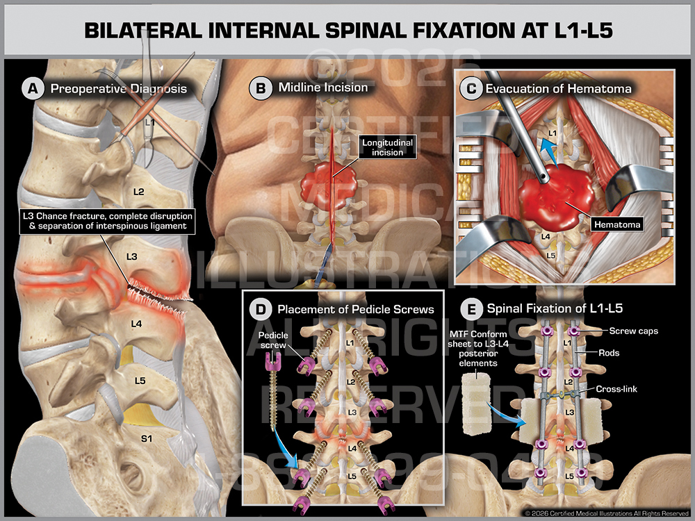Lumbar Fusion L1-L5 Medical Trial Exhibit