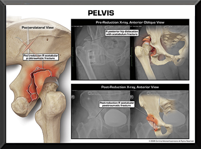 Trial Exhibits colorized films pelvis pelvic injury films