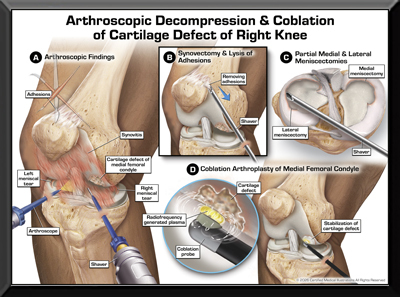 Arthroscopic Knee Medical Trail Exhibit