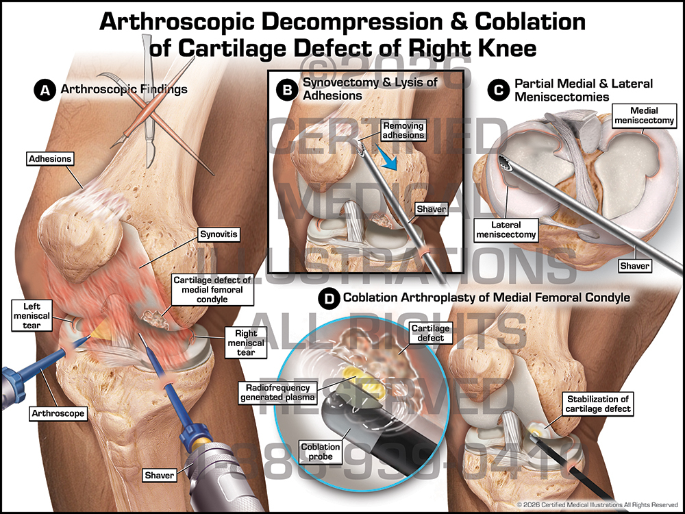 Coblation of Knee Surgery exhibit trial