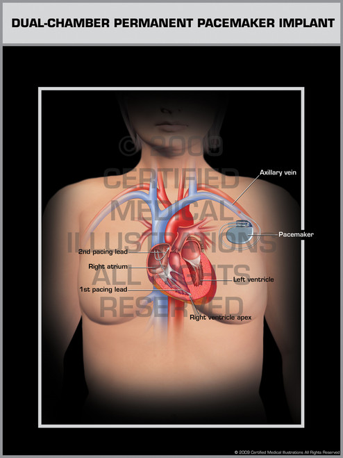 Dual-Chamber Permanent Pacemaker Implant Female