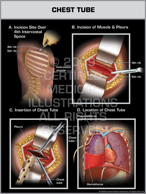 Chest Tube Male