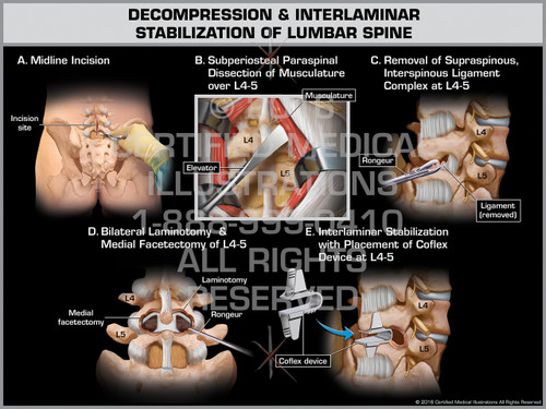 Decompression & Interlaminar Stabilization of Lumbar Spine - Print ...