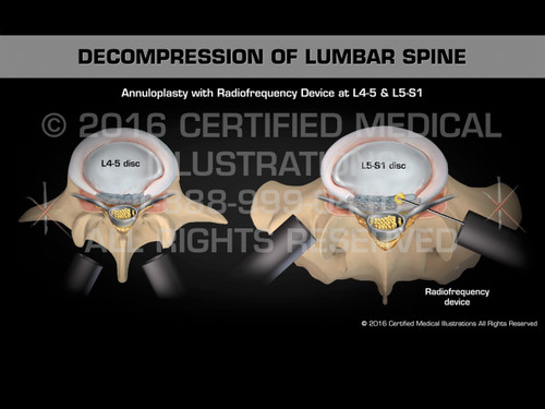 Decompression of Lumbar Spine - Medical Animation