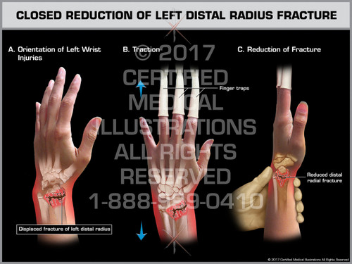 Closed Reduction of Left Distal Radius Fracture- Print Quality Instant ...