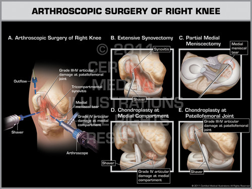 Arthroscopic Surgery of Right Knee