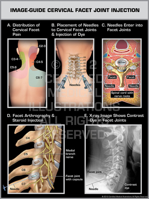 Image-Guide Cervical Facet Joint Injection Female