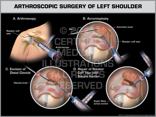 Left Dfr Surgery Arthroscopic Surgery of Left Shoulder