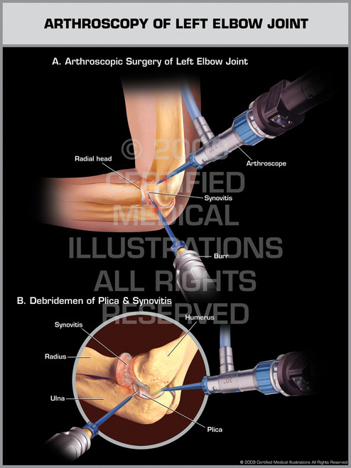 Arthroscopy of Left Elbow Joint