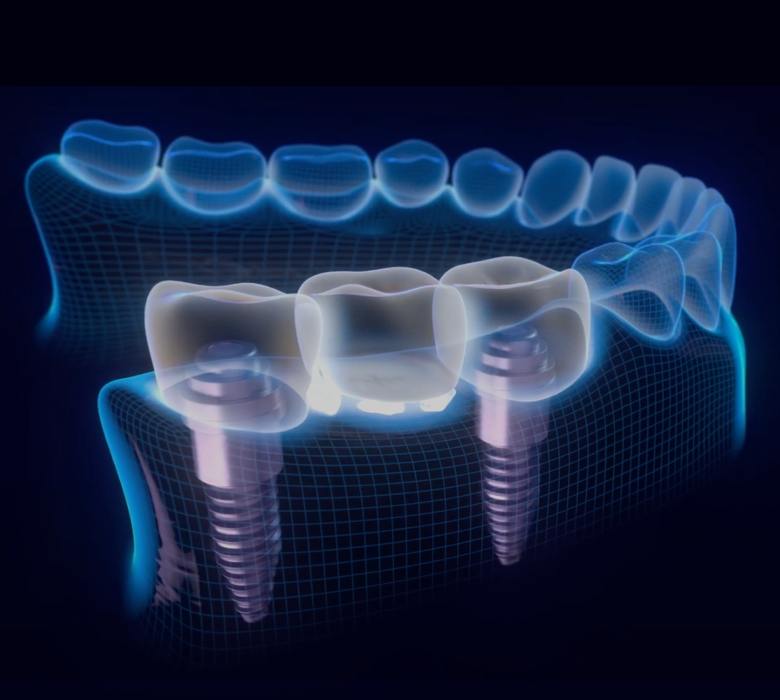 implants-how-to-brush-background-image