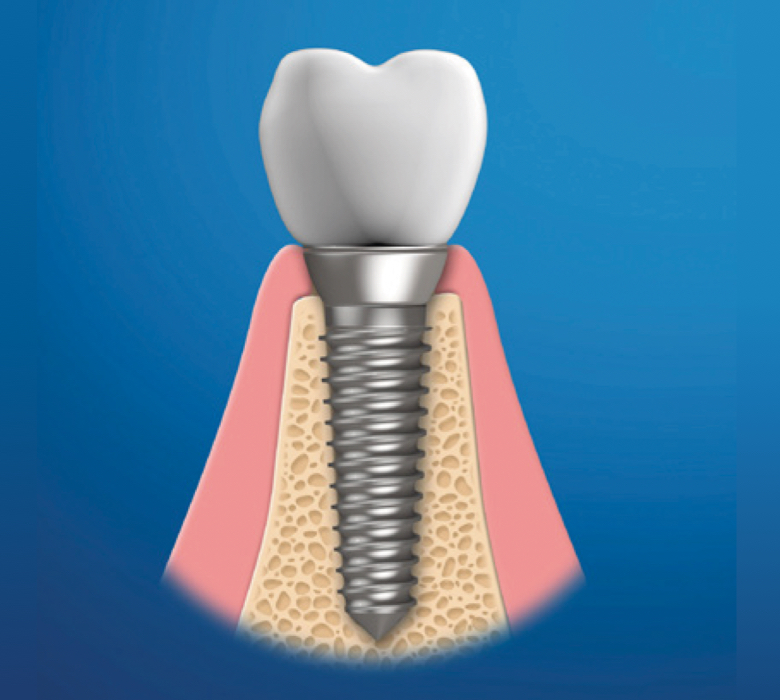 what-are-implants-background-image