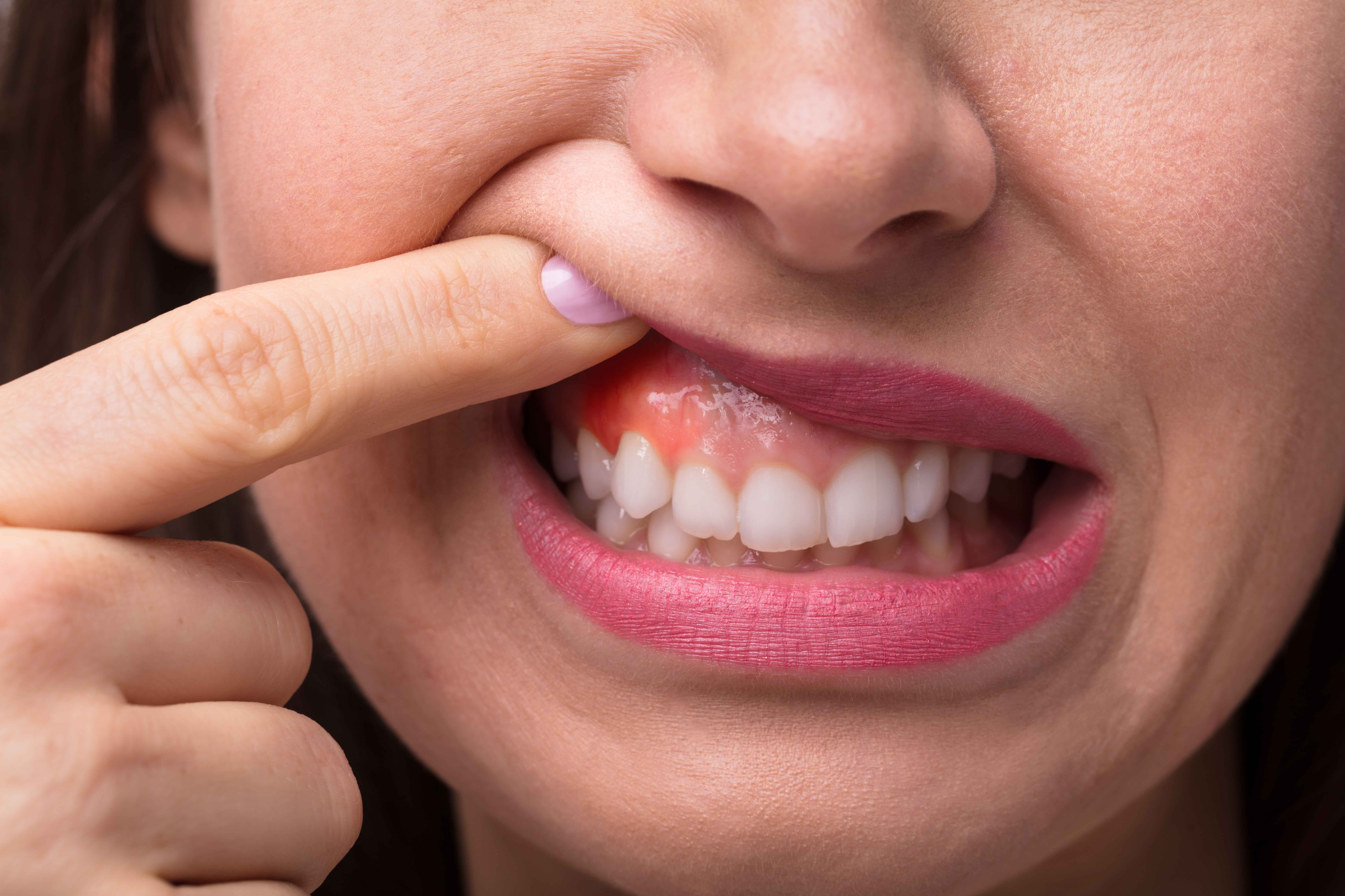 Woman showing red, inflamed gums