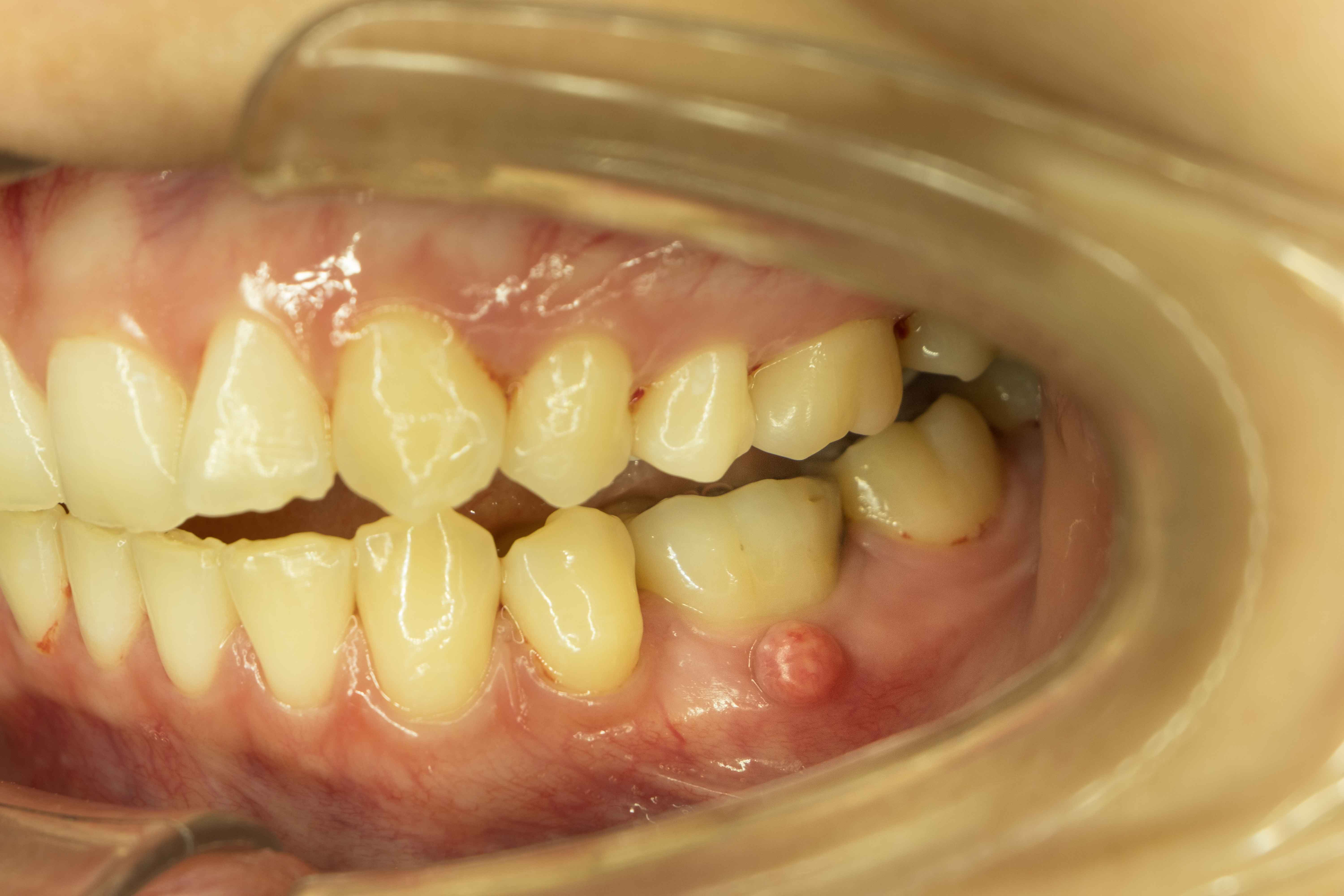 Gum abscess below premolar