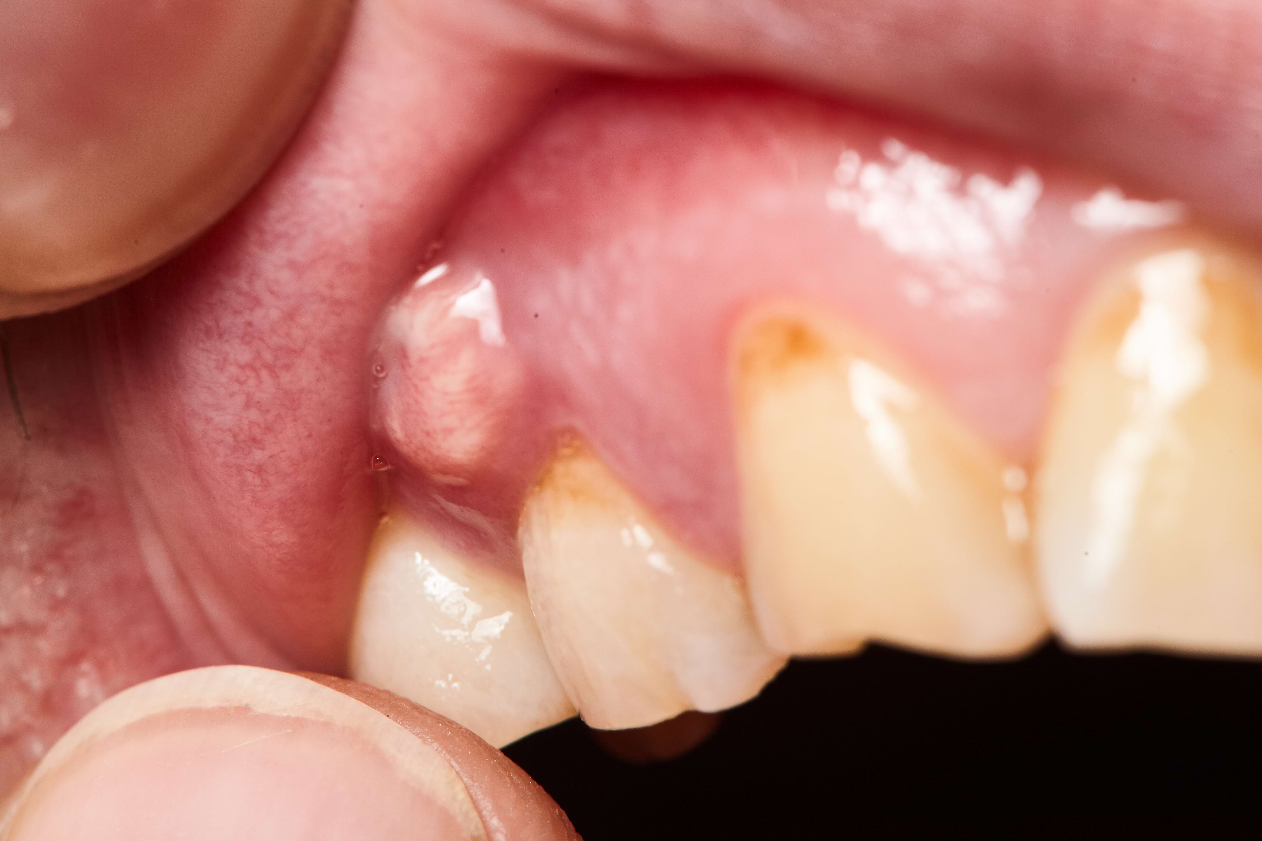 Advanced gum abscess above molar