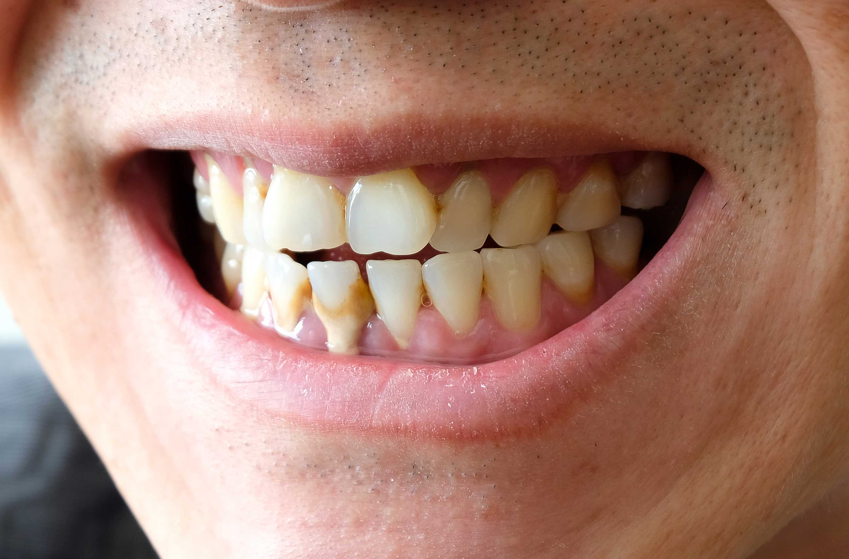 Close-up of teeth with dental calculus on them