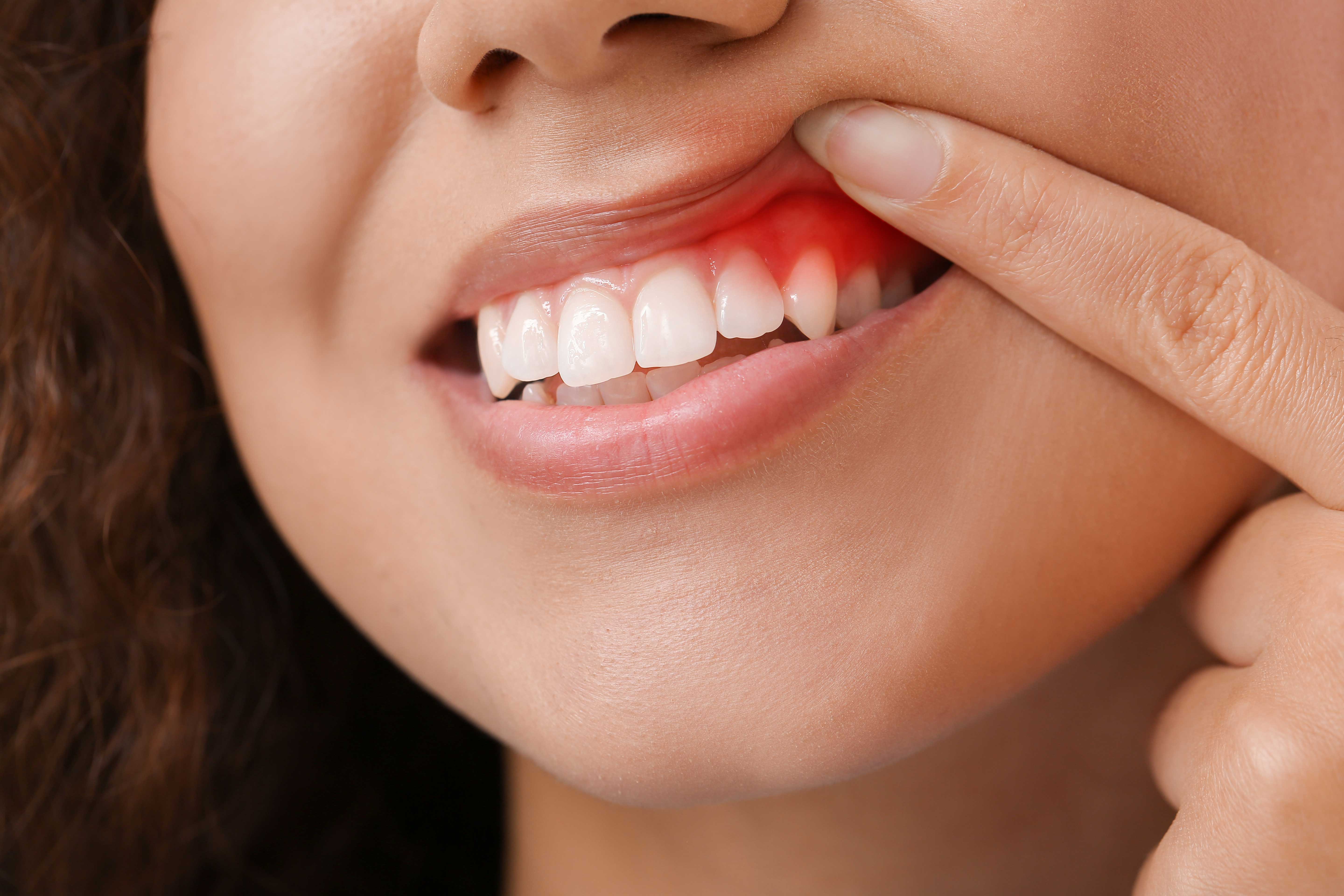 Woman showing red, inflamed gums above her teeth