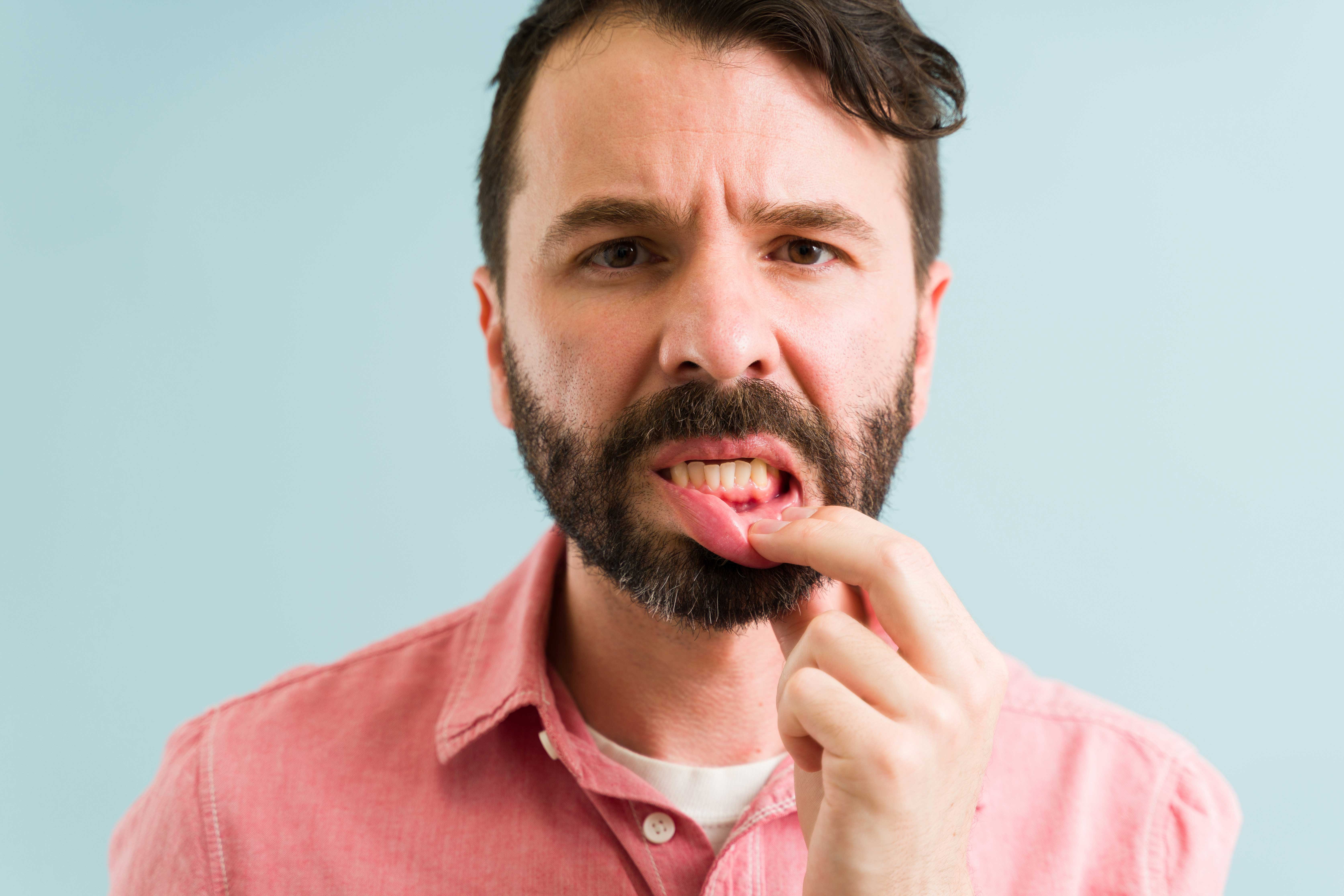 Man with red, irritated gums
