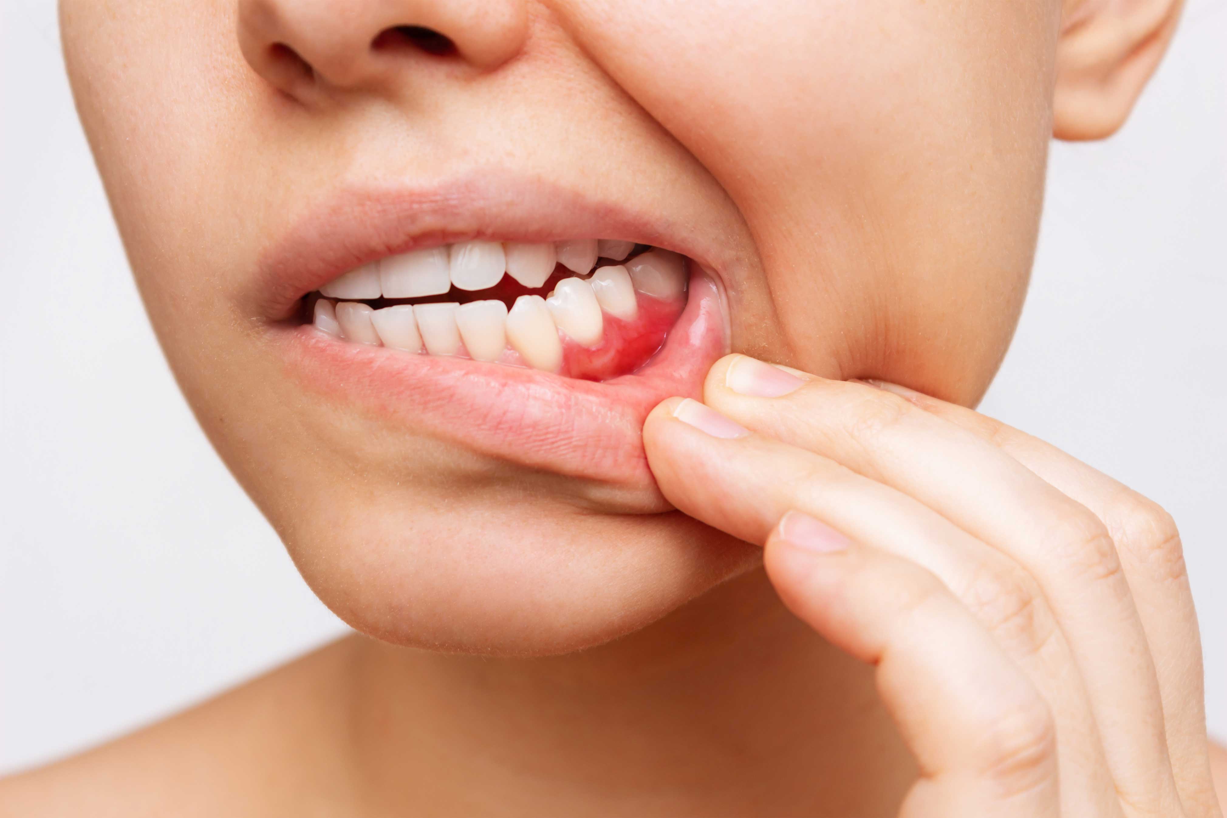Woman with inflamed, unhealthy gums