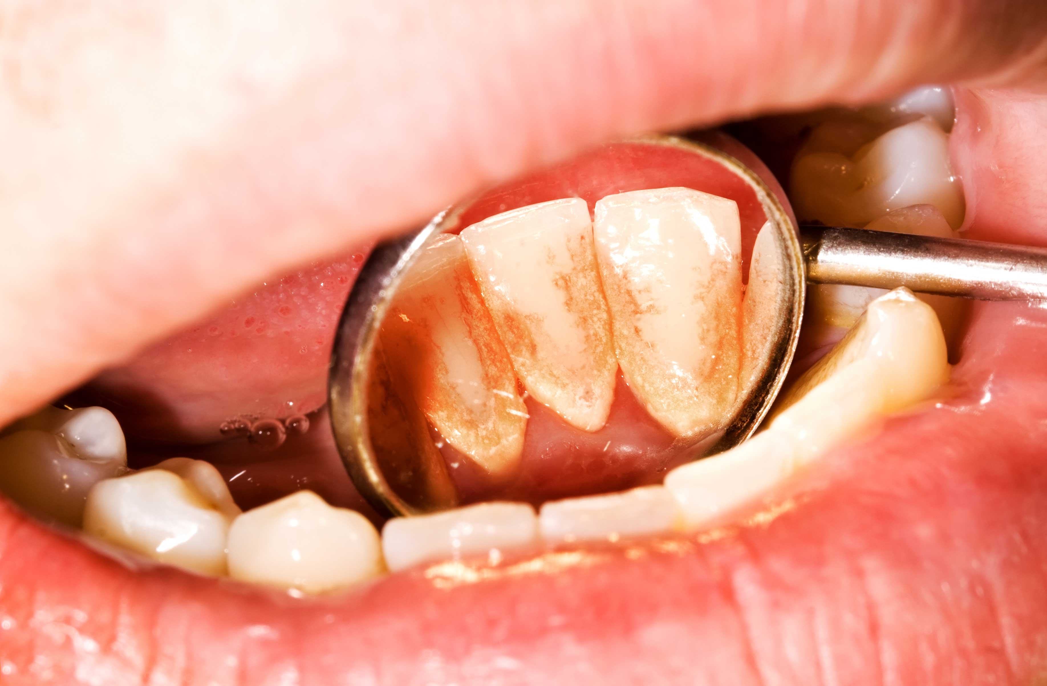 Close-up of teeth with yellow tartar deposits along the gumline showing hardened plaque buildup