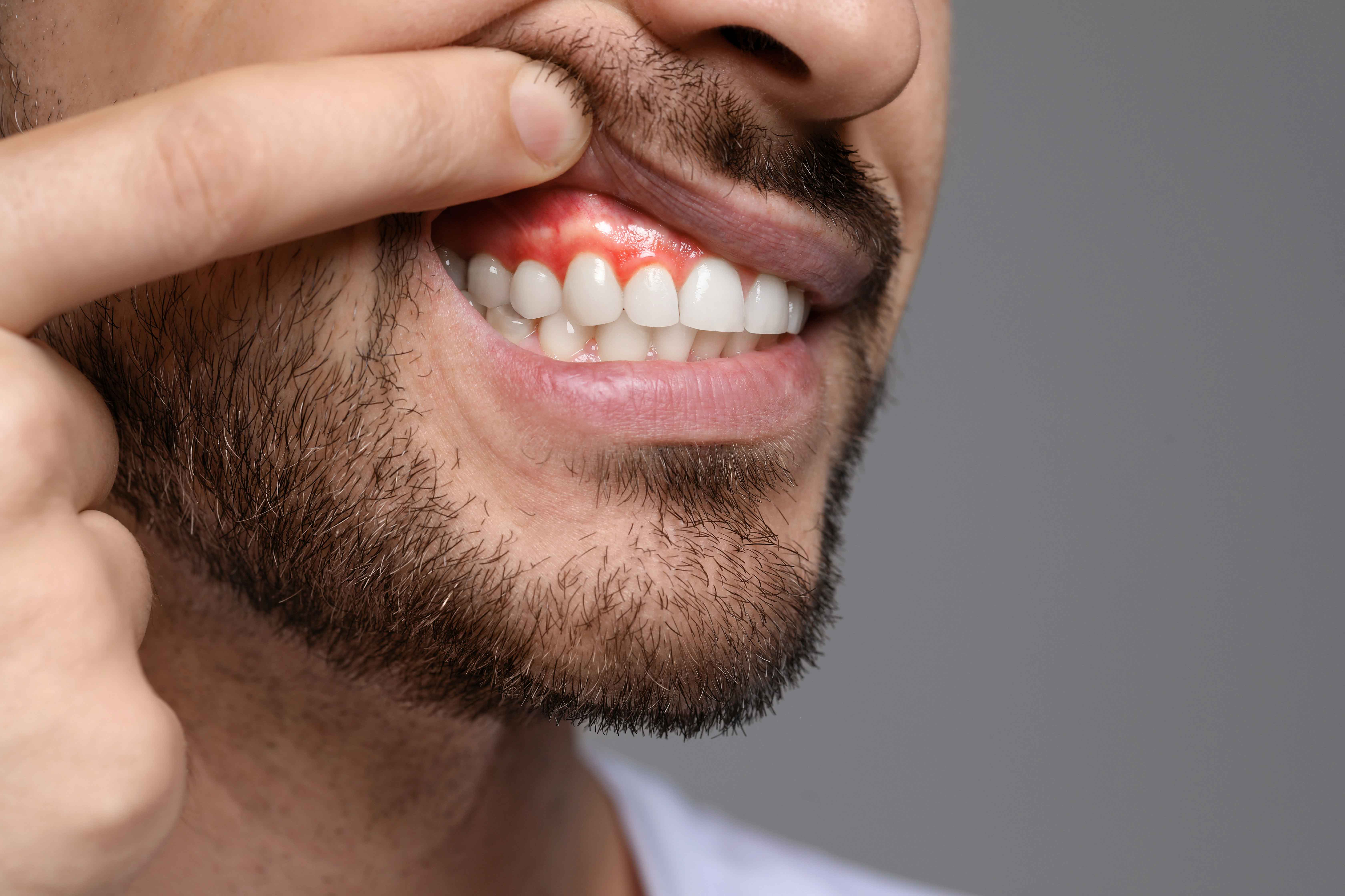 Man showing a gum abscess above his top teeth