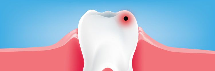 What are Dental Caries? Treatments, Signs, and Symptoms