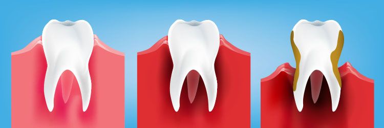 periodontal disease stages