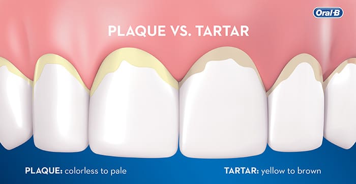 Both plaque and tartar buildup are common dental problems