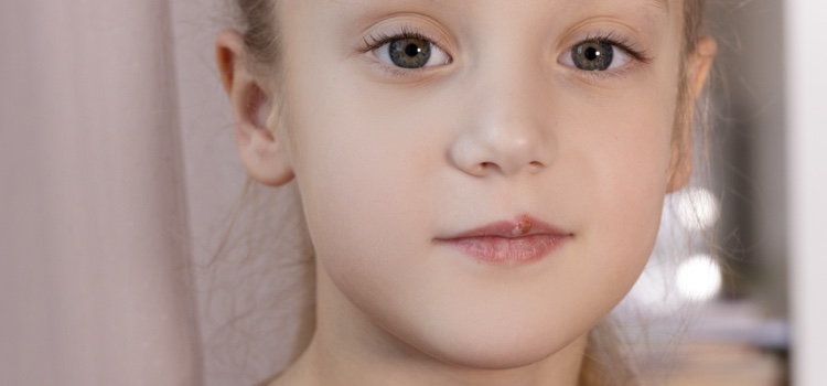 Cold sores in toddlers