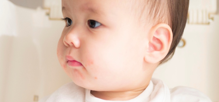 Rash while teething