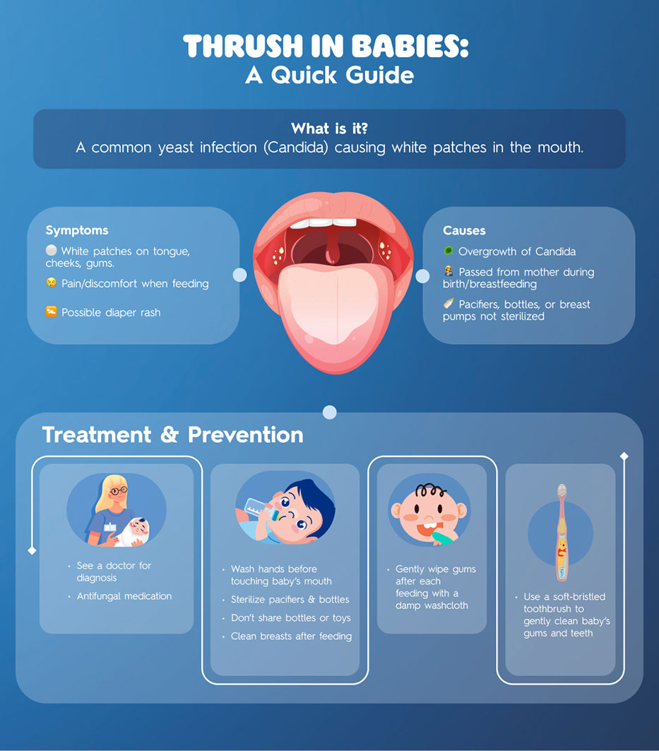 Thrush in babies: causes, symptoms, treatment