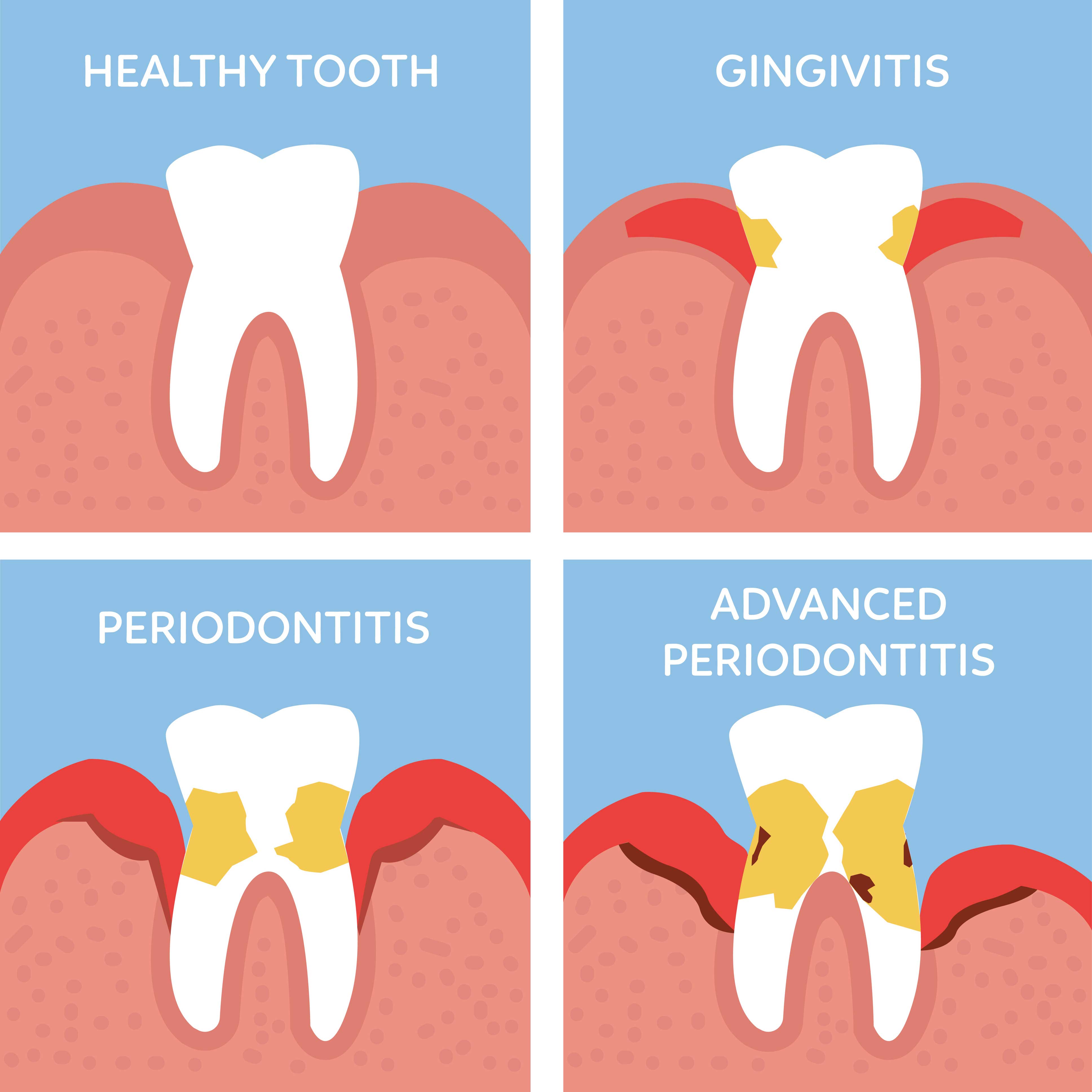 Visual progression of gum disease from healthy tooth to gingivitis, periodontitis, and advanced periodontitis