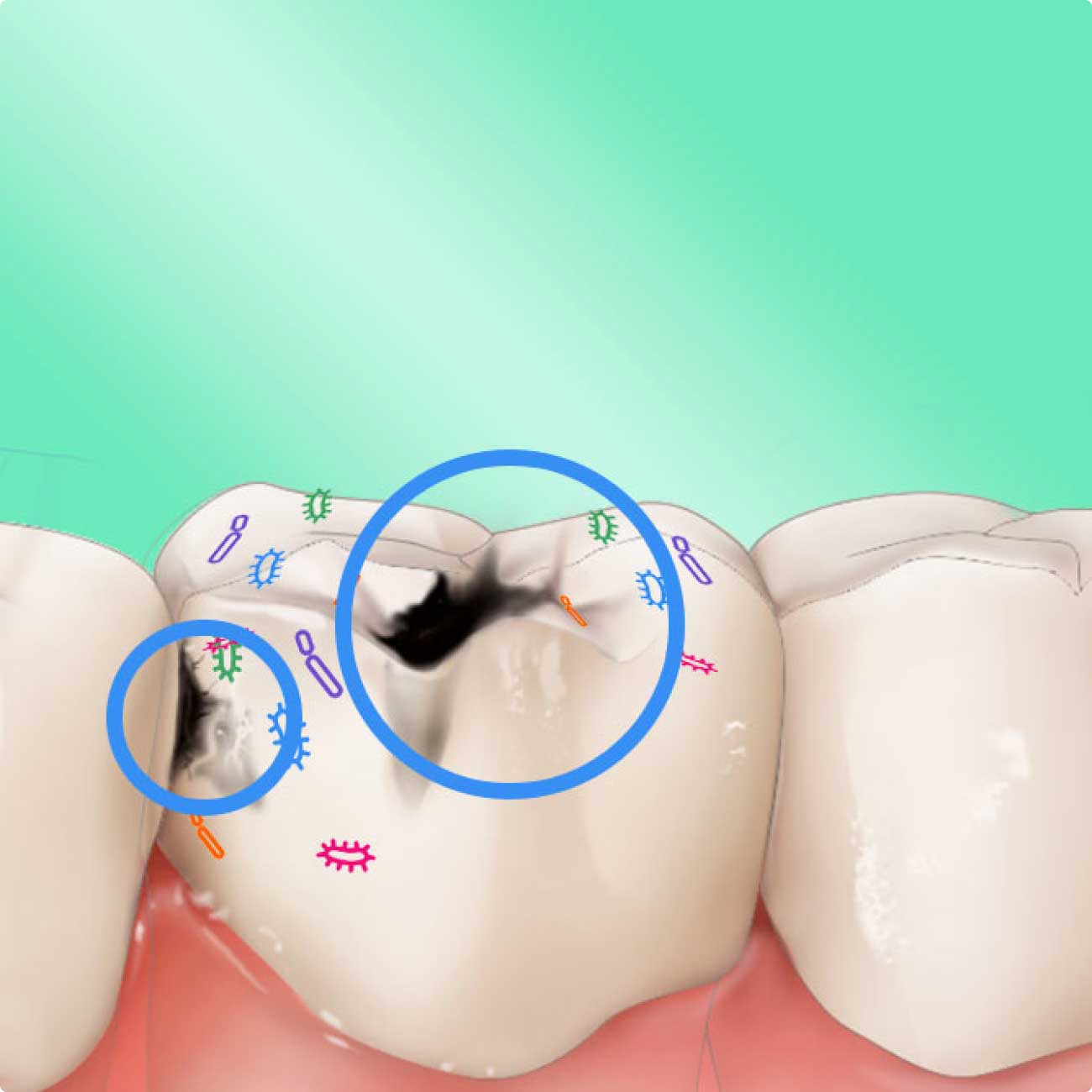 Graphic depicting plaque bacteria causing tooth decay and cavities
