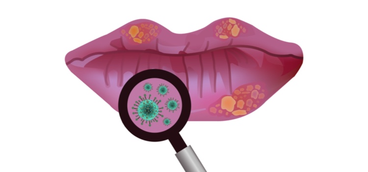 Herpes on lips