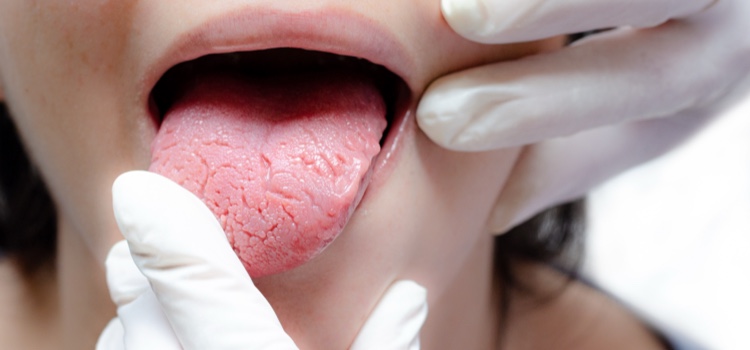 Close-up of a young woman with geographic tongue extending her tongue.