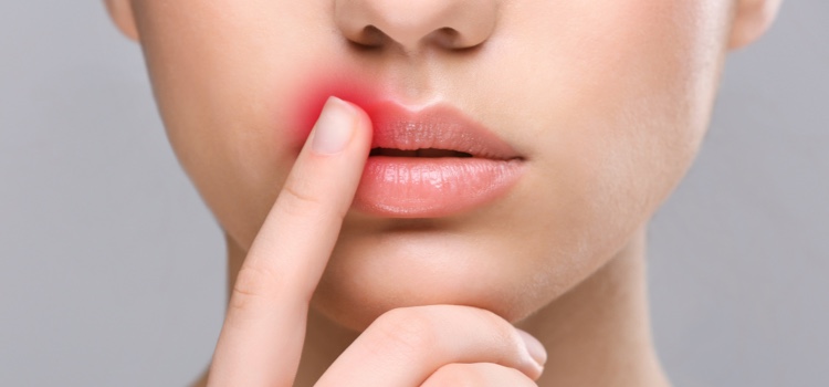 Cold sore on woman's lip