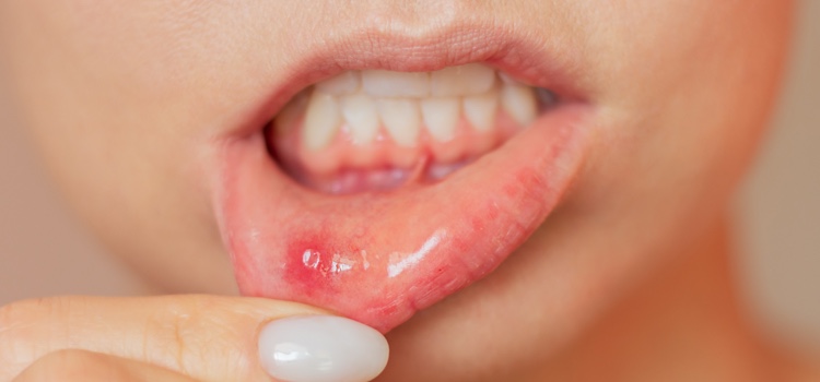 Ulcer on the side of the tongue.