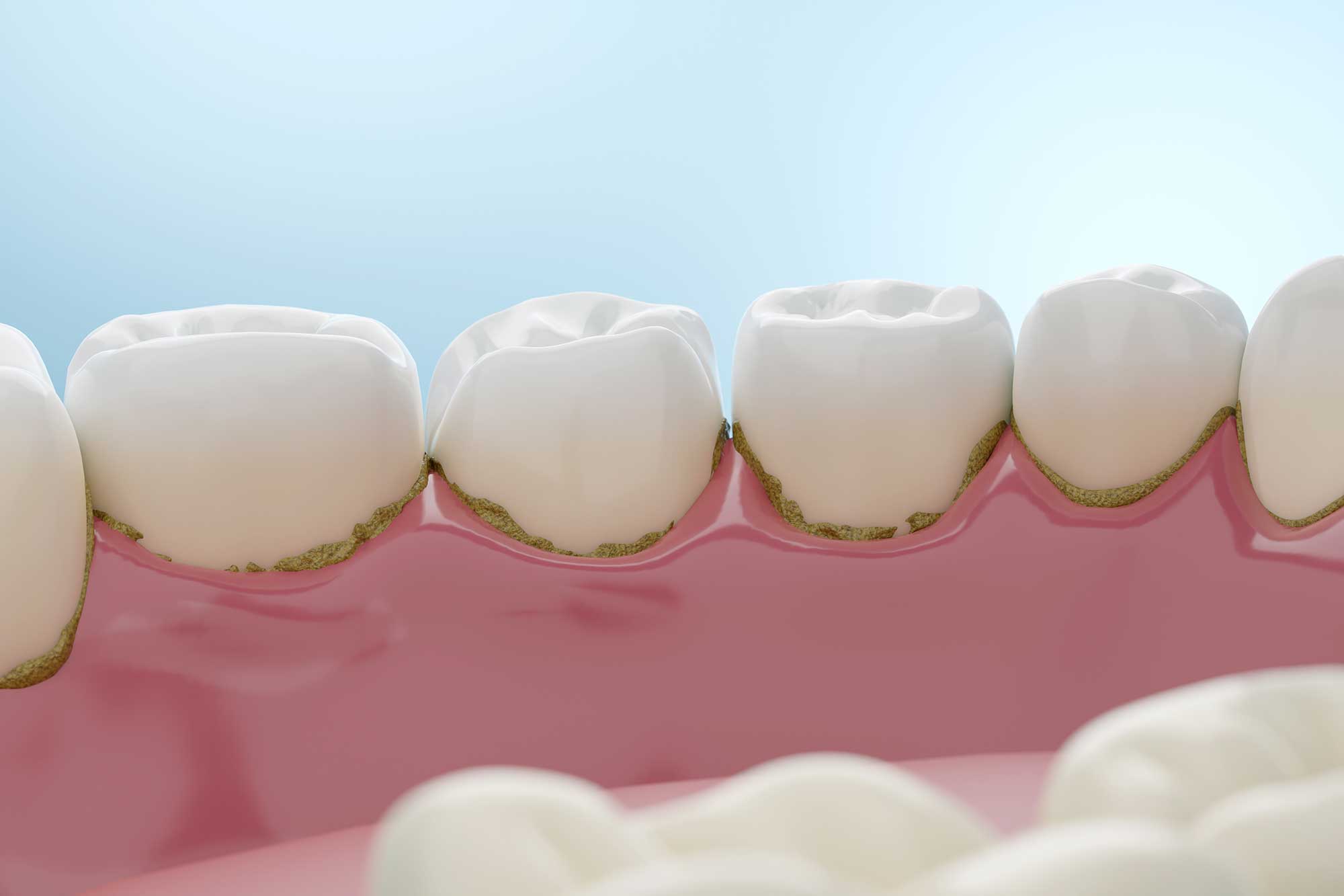 3d illustration of molars with cavities on the gumline