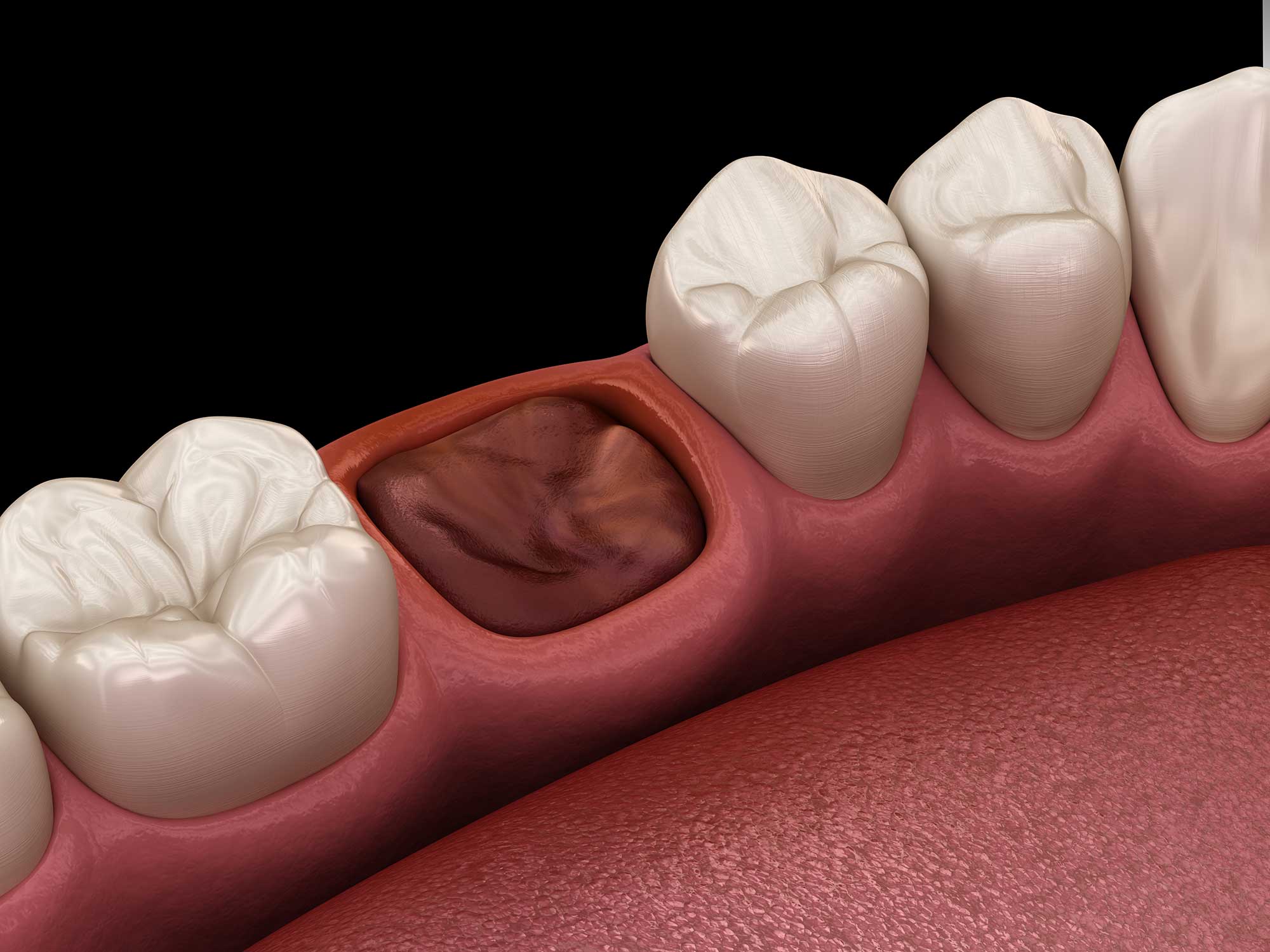 3D illustration showing gums with an extracted tooth image